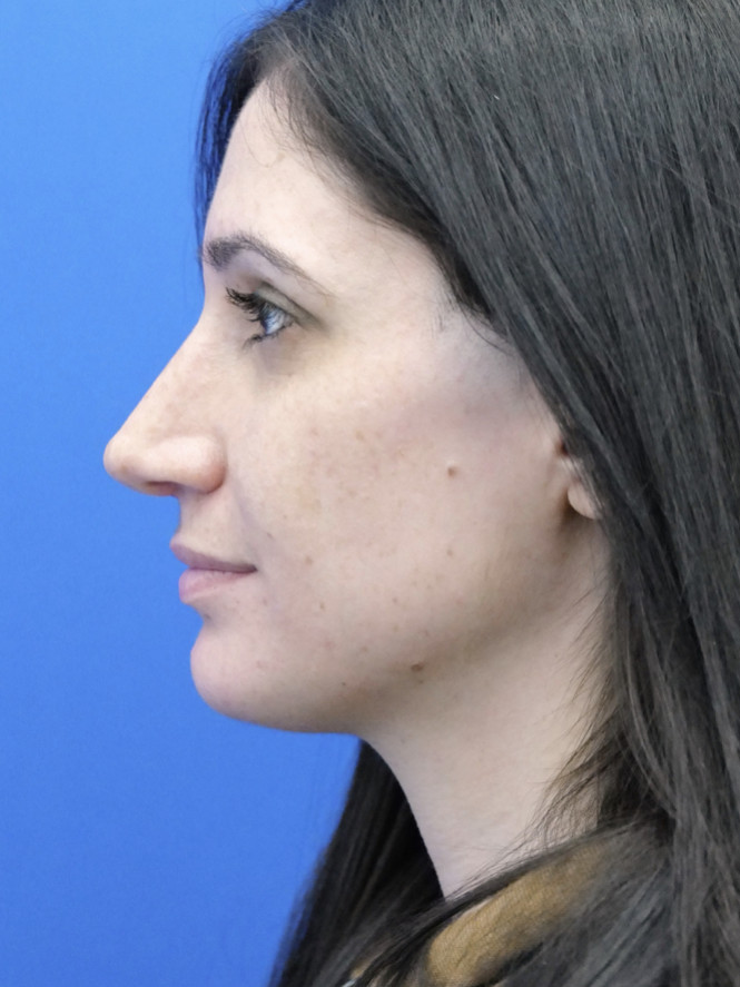 Case 6006 after Profile Enhancement