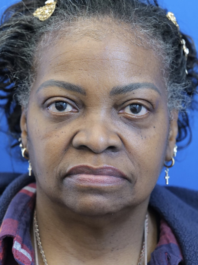 Case 7487 after Lower Eyelid Surgery — Orbital Fat Reposition