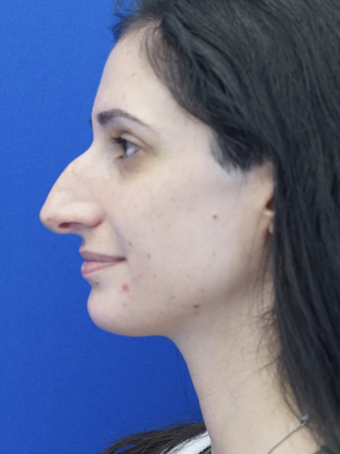 Case 6006 before Profile Enhancement