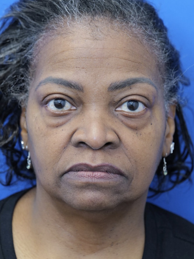 Case 7487 before Lower Eyelid Surgery — Orbital Fat Reposition