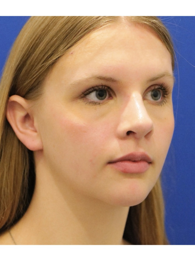 Soften Nasal Appearance — After