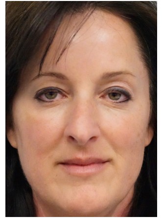 Botox Periorbital – Around the Eyes* — After