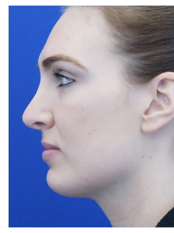 Profile Balance — After