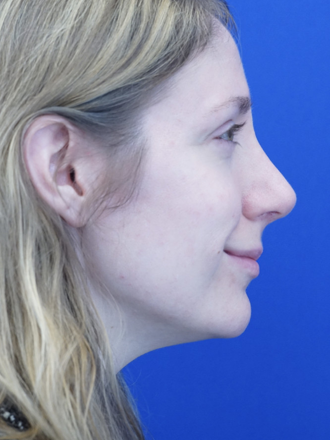 Nasal Profile Finesse — After