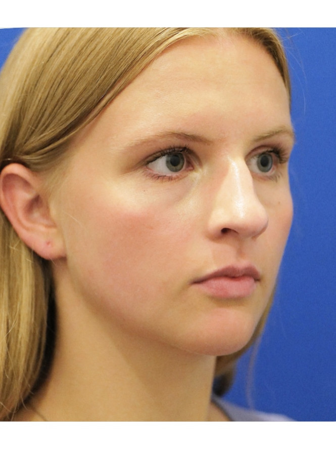 Soften Nasal Appearance — Before
