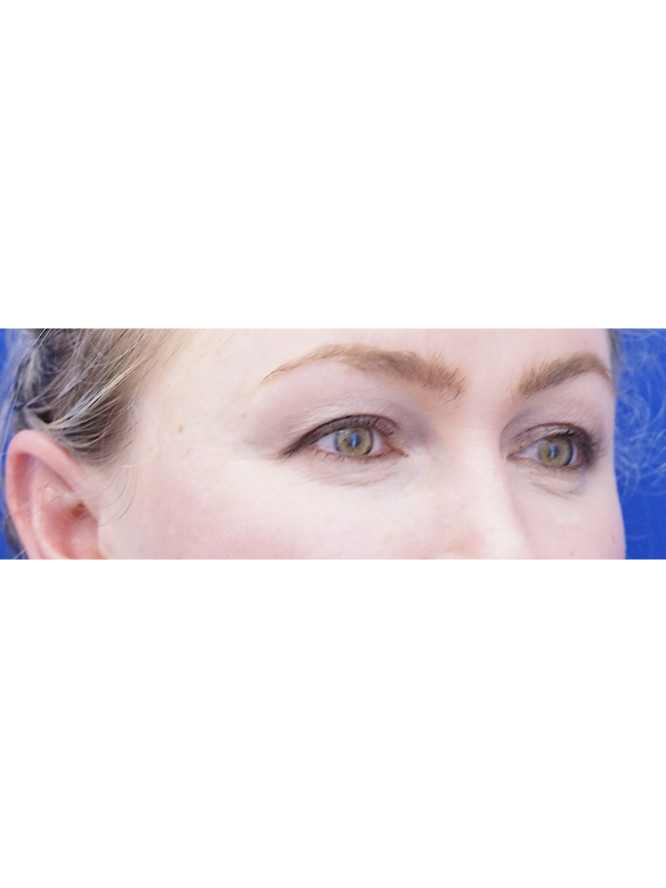 Elegant Eyelid Appearance — Before