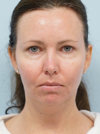 Radiesse to Nasolabial Folds* — Before