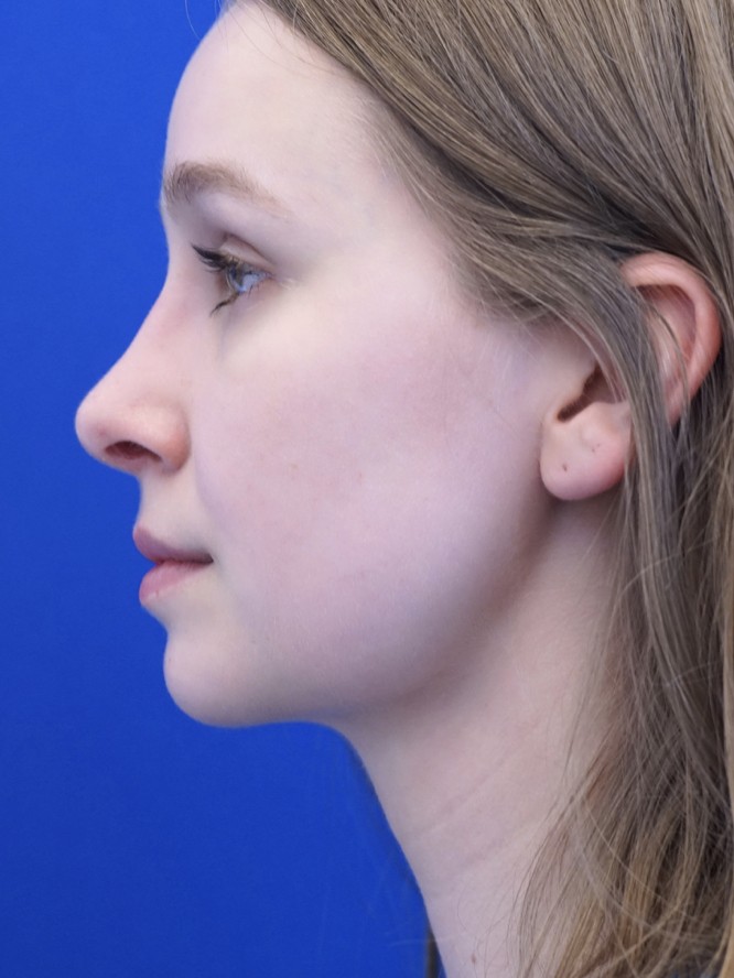 Facial Profile Plasty — After