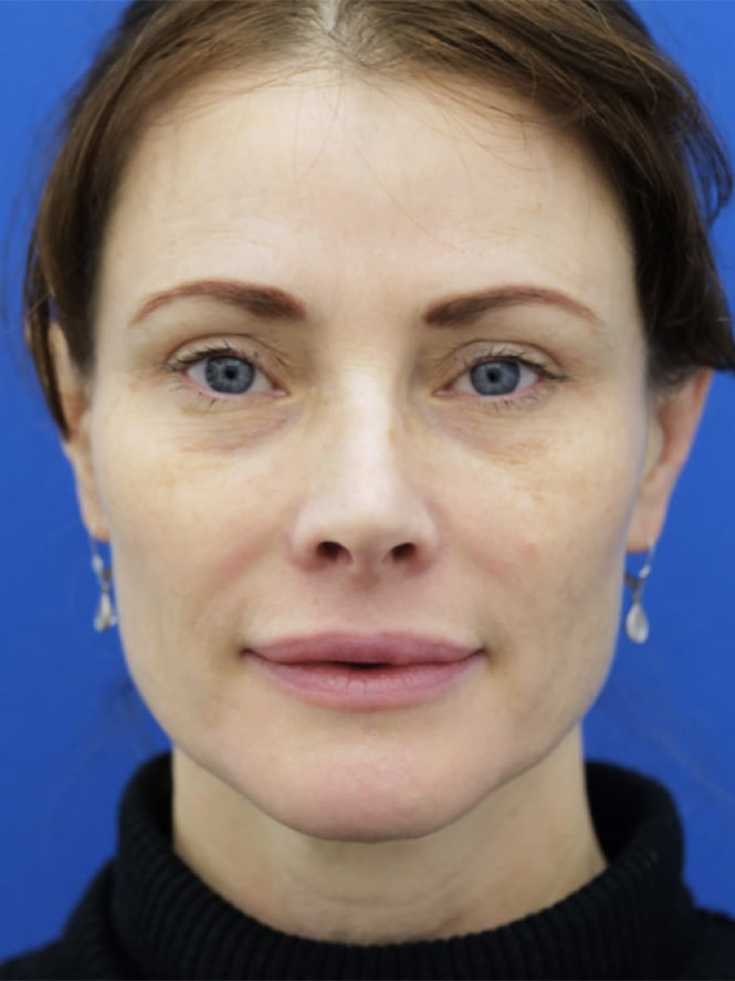 Case 7252: before Lower Lid Fat Reposition