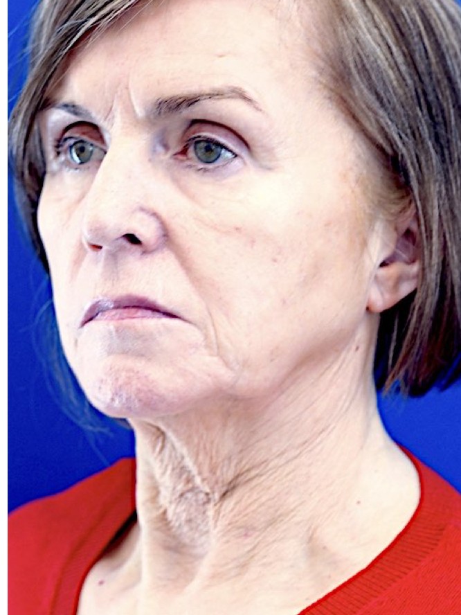 Deep Plane Lift and Fat Grafting — Before