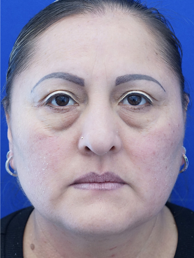 Lower Blepharoplasty Fat Reposition — Before