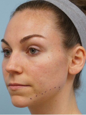 Fractional CO2 Laser Skin Resurfacing1* — Before