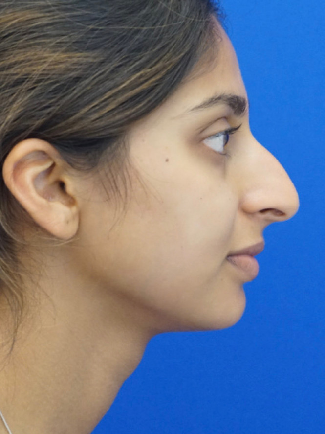 Natural Result — Before
