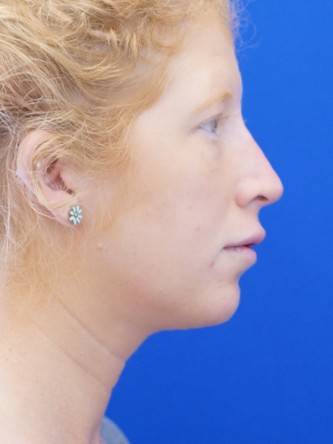 Liquid Rhinoplasty* — After