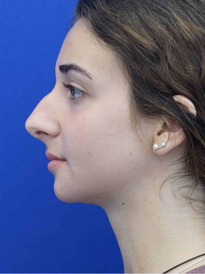 Classic Tension Nose — Before