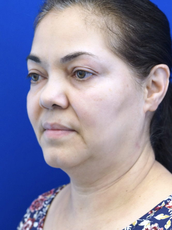 Deep Plane 2 Years Result — Before