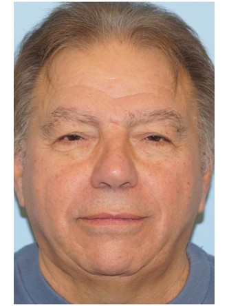 Visual Field Deficit – Eyelid Ptosis2* — Before