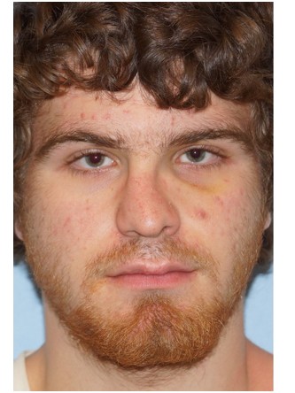 Nasal Fracture – Nostril Asymmetry* — Before