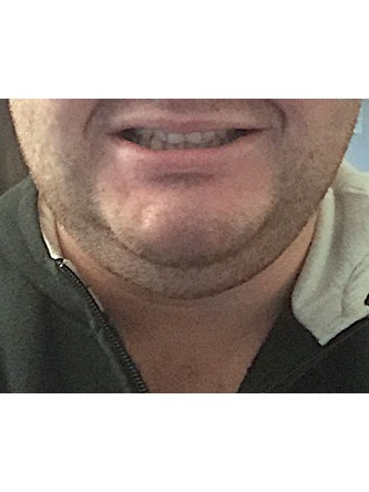 Neck Liposuction* — Before