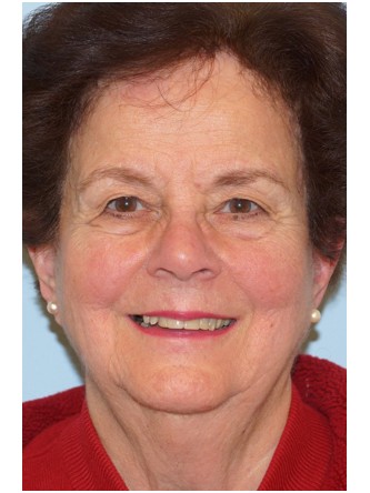 Visual Field Deficit – Eyelid Excess Skin1* — Before