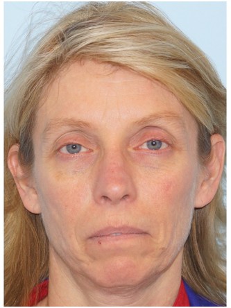 Upper Eyelid Droop1 (Ptosis)* — Before