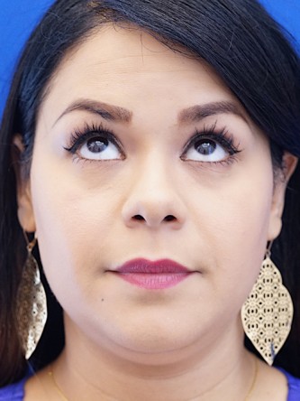 Twin Tear Trough Fillers* — Before