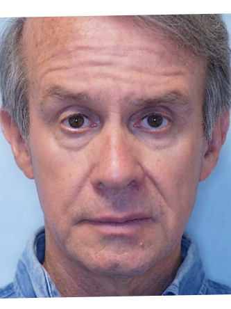 Droopy Eyelid Surgery* — After