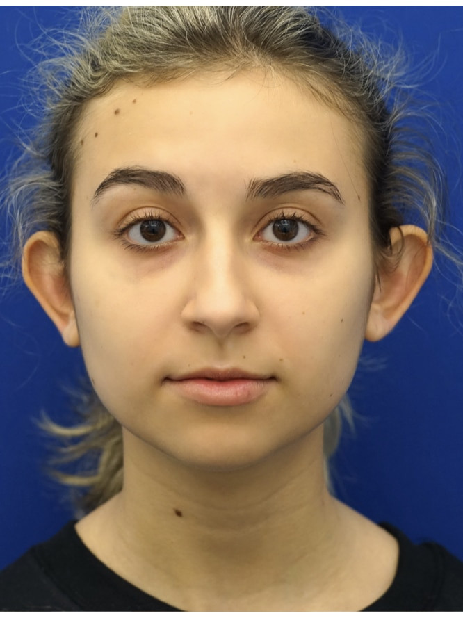 Flaring Ears — Before
