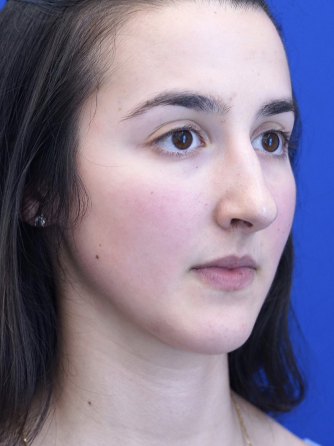Endonasal Finesse Rhinoplasty — Before