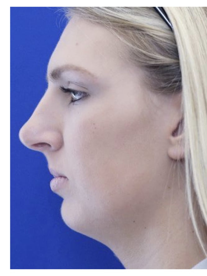 Profile Balance — Before
