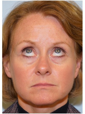 Lower Eyelid Excess Fat Pad1* — Before