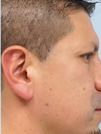 Protruding Ears – Upper Third* — After
