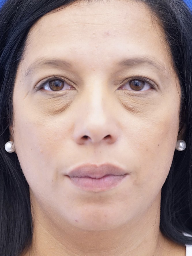 Lower Lid Fat Reposition — Before