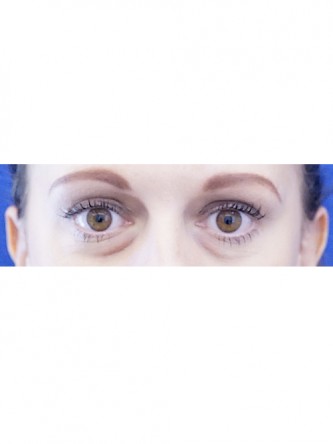 Lower Eyelid Hollow* — Before