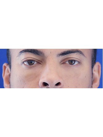 Fat Transfer to Lower Eyelid* — After