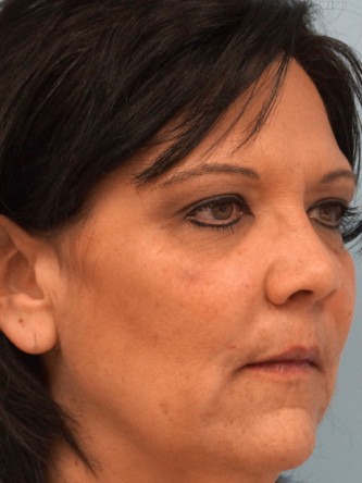 Radiesse to Malar Cheek and Laugh Lines* — After