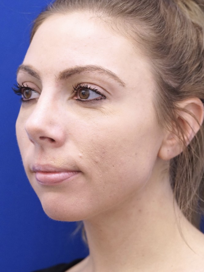 Endonasal Dainty Nose — After