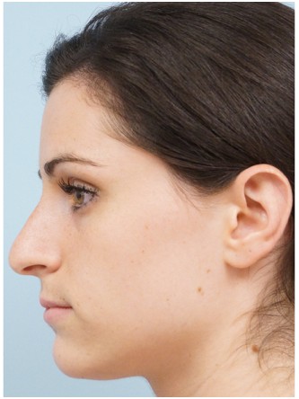 Mild Dorsal Hump & Droopy Tip1* — Before