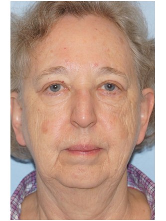 Visual Field Deficit – Eyelid Excess Skin3* — After