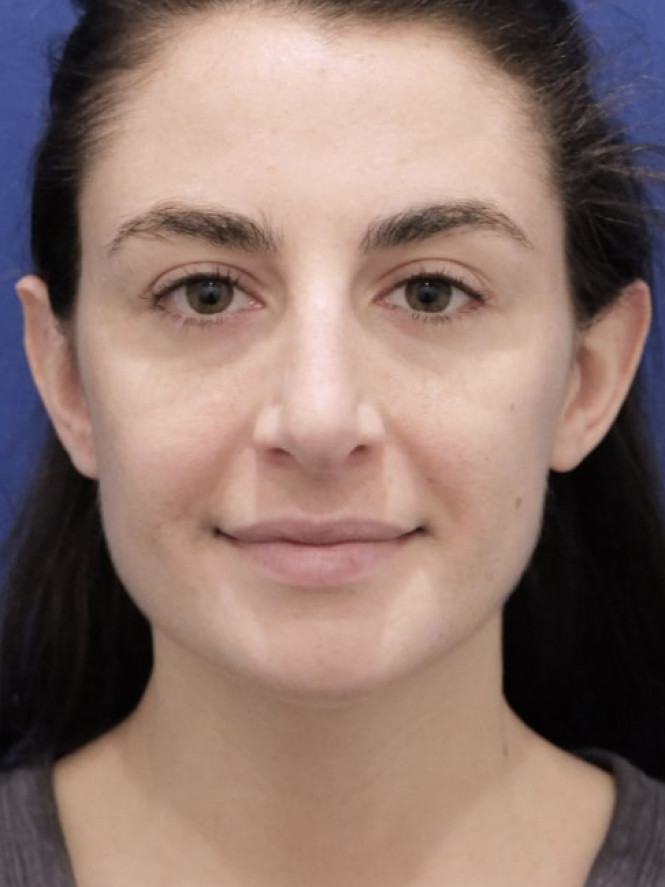 Earlobe Reduction — After