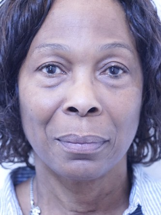 Tear Trough Under Eye Enhancement — Before