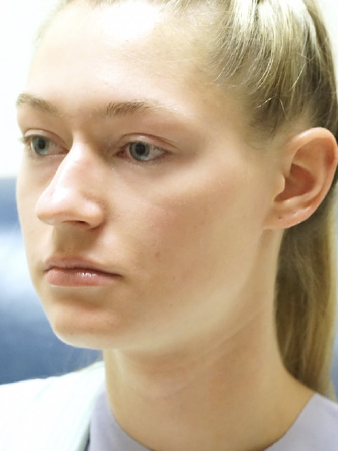 Nasal Profile Plasty — Before