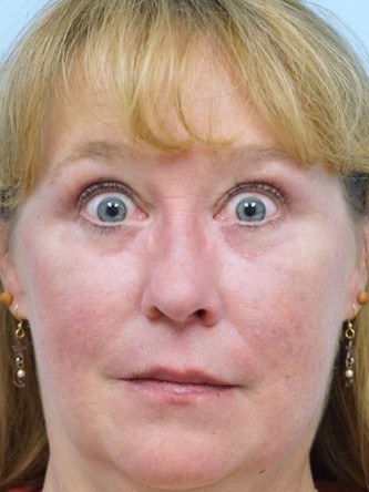 Upper and Lower Eyelid Blepharoplasty* — After