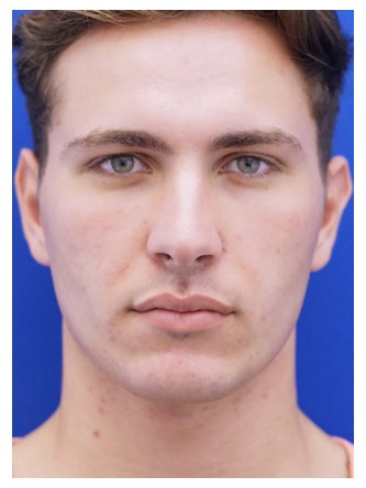 Buccal Fat Excision — After