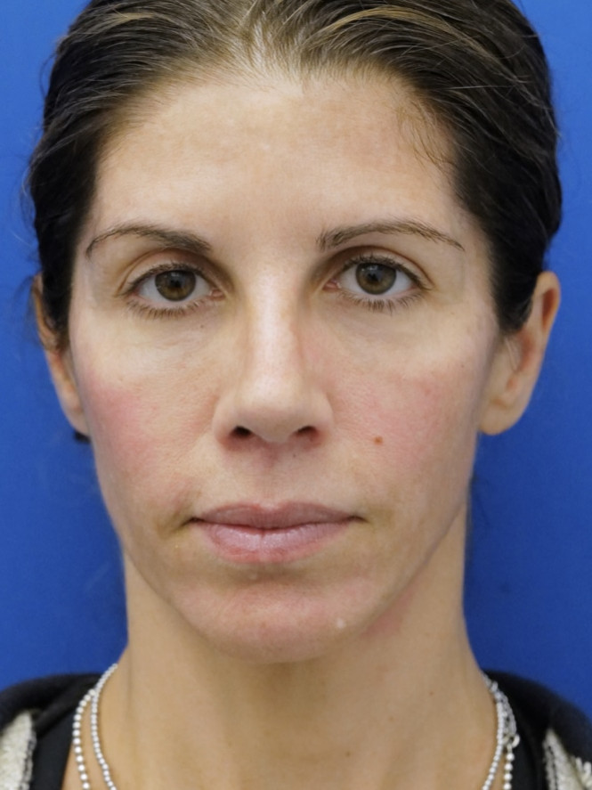 Brow Tip Aesthetic Line — After