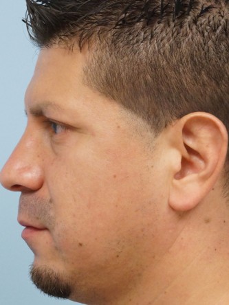 Protruding Ears – Upper Third* — Before