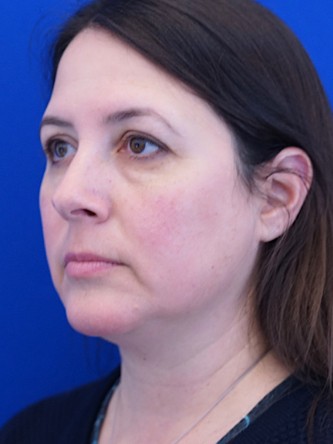 Facelift, Eyelid Lift, and Chin Liposuction* — Before