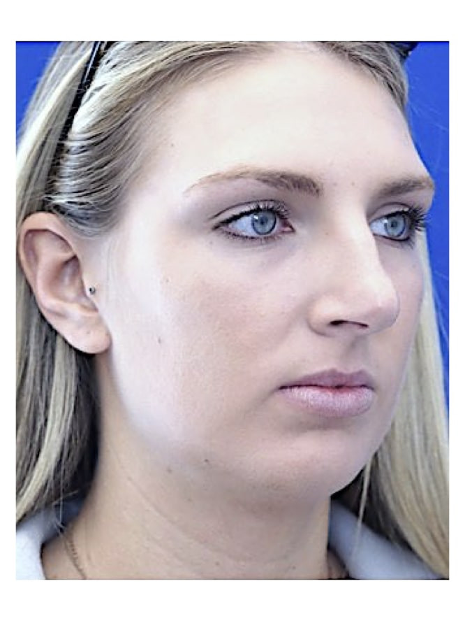 Tension Nose — Before