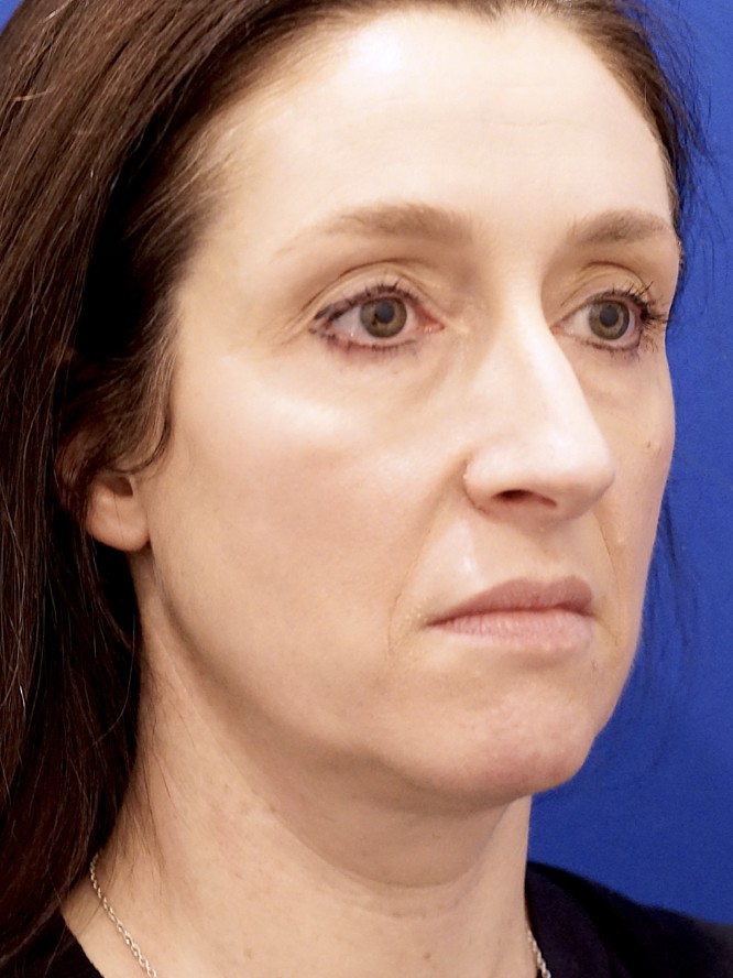Nasal Aesthetic Nuances — Before