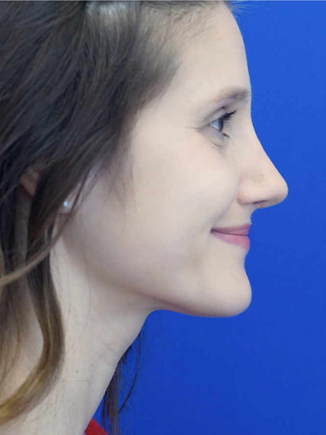 Case 3291: after Nasal Profile Bliss